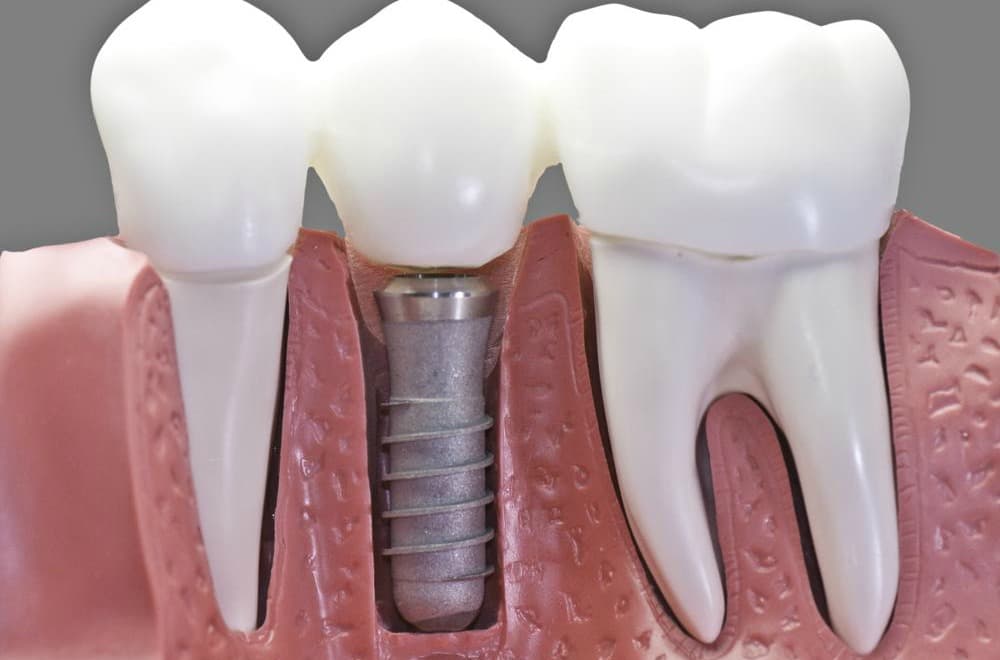 Ordenan a ART cumplir con implantes a trabajador que perdió tres dientes en un accidente laboral